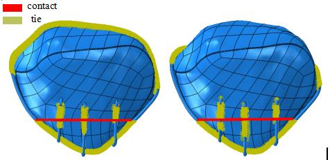 改良前后独立垂直钢丝内固定模型中的接触关系