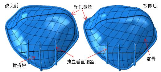 改良前后独立垂直钢丝内固定模型